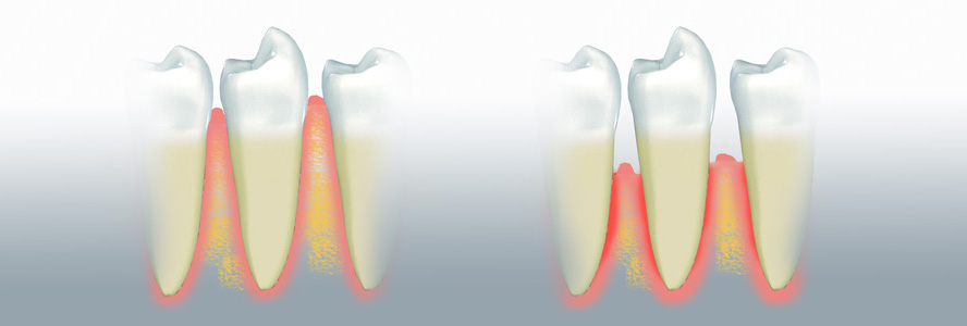 Erfolgreiche regenerative Behandlung ausgeprägter, parodontaler Defekte 