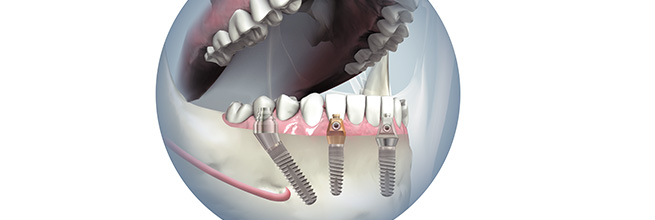 Minimal invasive Implantation und Sofortversorgung am Tag der Operation. Feste Zähne an einem Tag sind möglich.